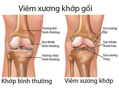 Bệnh viêm khớp ở người lớn và trẻ em