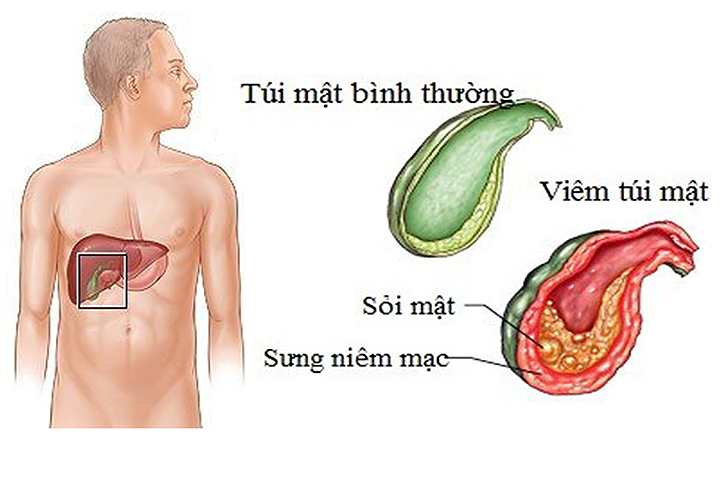 Mách bạn vô vàn lợi ích và tác dụng của bơ hạt điều cho sức khỏe 5 sử dụng bơ hạt điều tránh nguy cơ sỏi mật