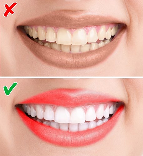 Màu răng: Răng trắng, bạn có thể chọn bất kỳ màu nào bạn thích; Răng vàng: màu hoa hồng, màu cam, màu đỏ nhạt. Tránh các màu tím, nâu và màu đỏ tươi sáng.