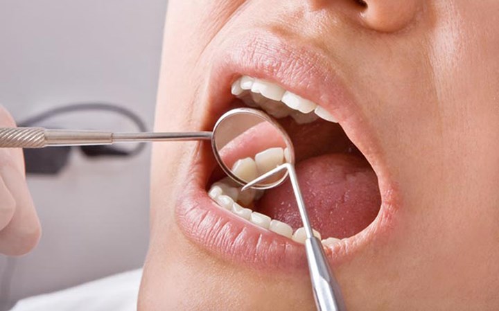 Hỏng men răng: Nghiên cứu cho thấy uống nước chanh có thể làm hỏng men răng do chanh có tính axit cao. Khi uống vào, axit này sẽ kích thích nướu răng và làm mềm men răng, làm tăng nguy cơ xói mòn răng vì lớp men răng của bạn khá mỏng và có thể bị bào mòn dần.