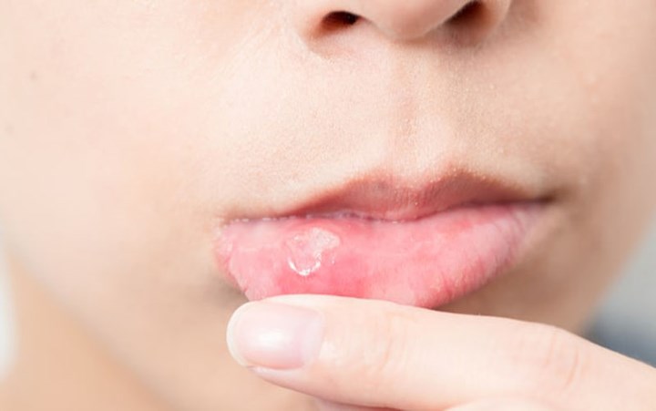 Nhiệt miệng nặng hơn: Axit xitric trong chanh có thể làm cho các vết loét của bạn tệ hơn và thậm chí gây ra nhiều hơn nữa. Do đó, bạn không dùng chanh hoặc bất kỳ trái cây họ cam quýt nào nếu bạn bị nhiệt miệng cho đến khi vết loét được chữa lành hoàn toàn.