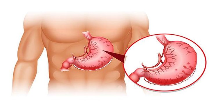 Chứng sa dạ dày: Sa dạ dày là một chứng bệnh của dạ dày thường gặp nhất đối với những người có cơ thể gầy yếu. Cơ thể quá gây khiến cho dạ dày phải làm việc một cách mệt nhọc, việc nhào trộn thức ăn gặp nhiều trục trặc đáng kể. Người quá gây mắc chứng sa dạ dày sẽ luôn có cảm giác đầy bụng, hay bị nấc cụt, nôn nao và đau dạ dày…