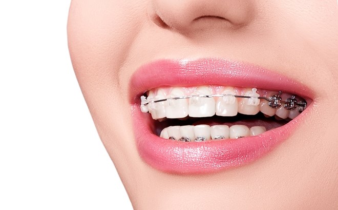 Niềng răng ở tuổi 30: Quyết định phi lý hay một sự đầu tư sinh lời?