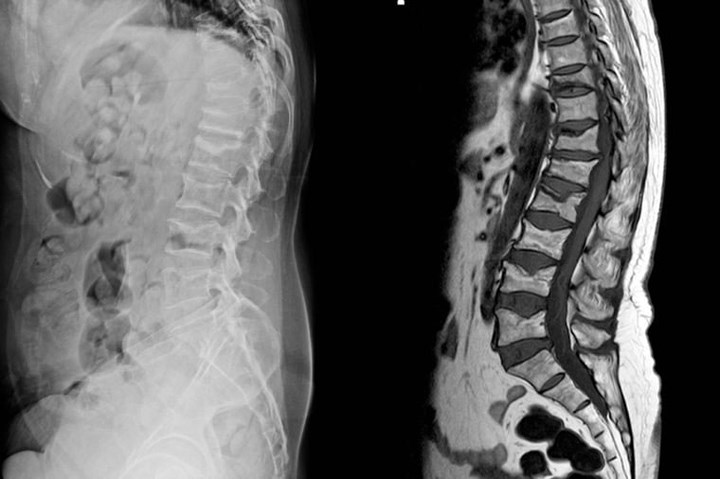 Khi bệnh loãng xương đi kèm với triệu chứng đau lưng thì rất có thể bạn đã bị tổn thương đốt sống số 1