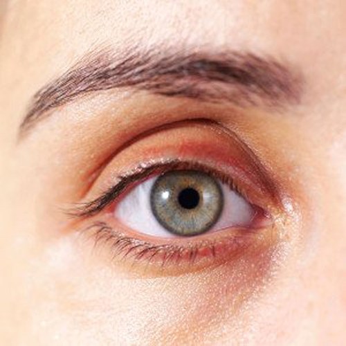 Vàng da quanh mắt, mũi hoặc miệng: Dấu hiệu này có thể là lý do để bạn tránh xa thịt