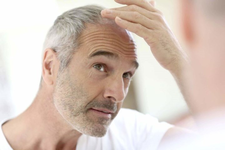 Rụng lông mi, rụng tóc: Lông mày hoặc lông mi mỏng đi cảnh báo các vấn đề với tuyến giáp