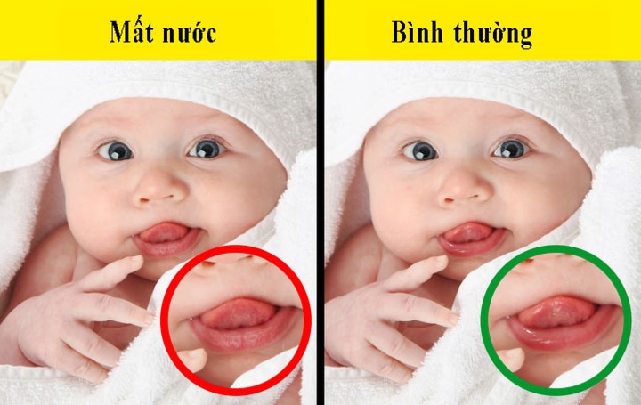 Trẻ thuộc lứa tuổi nào cũng có thể nhiễm rotavirus nhưng bệnh thường gặp ở trẻ dưới 2 tuổi