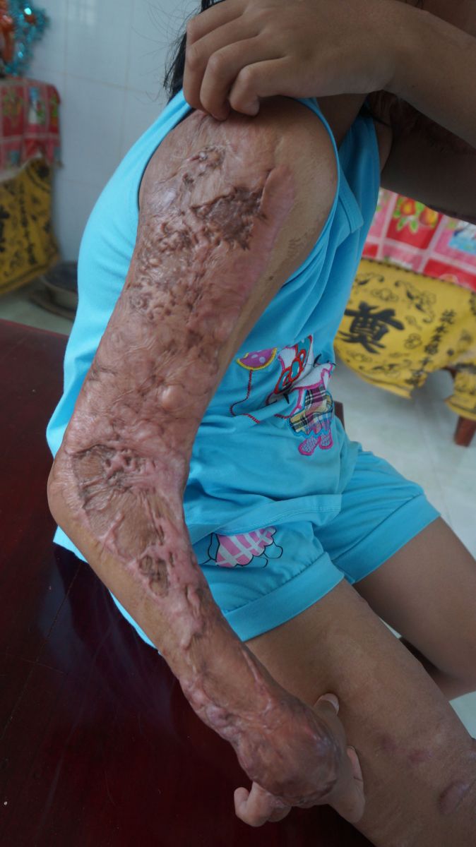 Cánh tay phải của con gái lớn chị Ngạt bị chấn thương sau vụ tai nạn giao thông