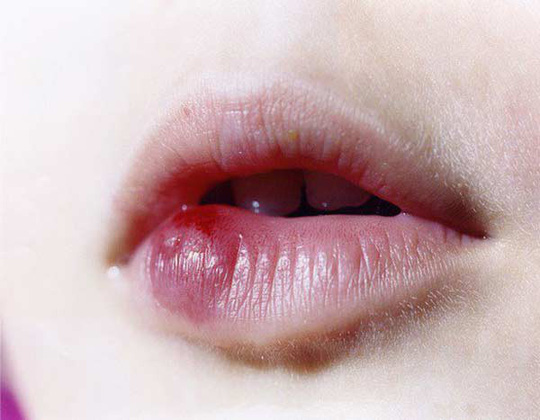 Biến chứng như vón cục hay cứng đơ là chuyện thường xuyên xảy ra khi tiêm filler vào môi
