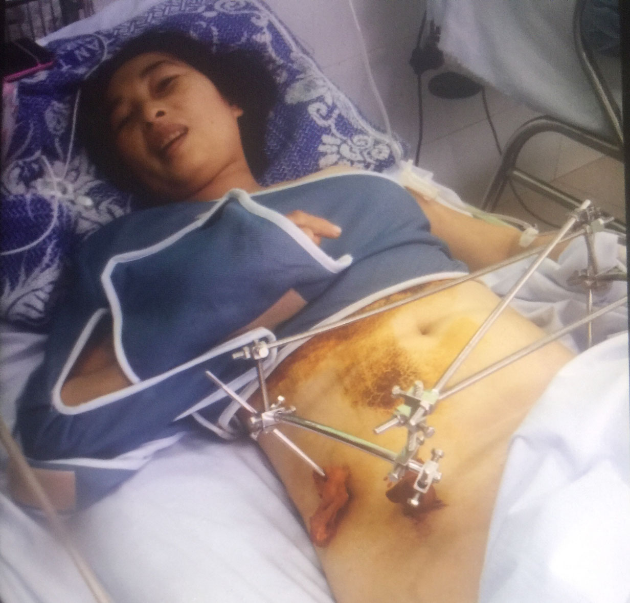 Chị Trần Thị Dàng bị thương rất nặng, hiện đang điều trị tại Bệnh viện Chợ Rấy