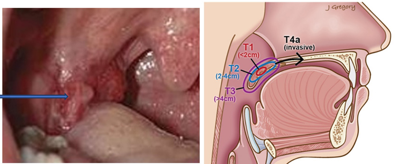 Khối u ác tính ở họng