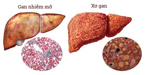 Thói quen xấu nhiều người đang bức tử lá gan của mình