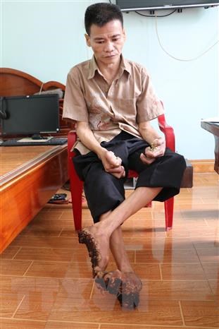 Anh Nguyễn Văn Sơn thường xuyên đau đớn vì bị căn bệnh hành hạ. (Ảnh: Đức Phương/TTXVN)