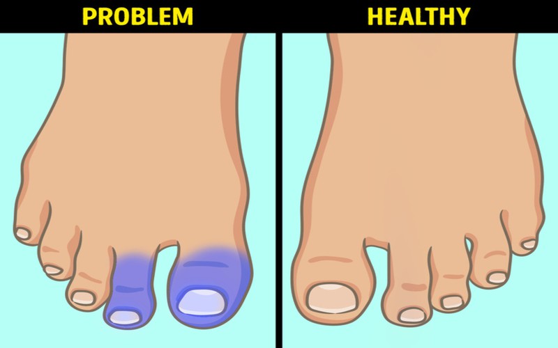 Xuất hiện màu xanh hoặc màu tím trên da chân: Trường hợp ngón chân của bạn thay đổi màu sắc ngay cả khi thời tiết ấm áp hay chân không bị lạnh, thì đây có thể là dấu hiệu cảnh báo về hội chứng ngón chân xanh, xảy ra khi các mạch máu bị chặn lại.