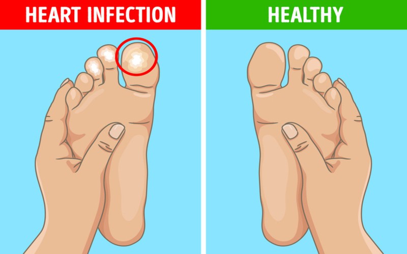 Những cục u gây đau đớn ở ngón tay và ngón chân: Các khối u gây đau có thể phát triển đột ngột và kéo dài hoặc một vài giờ đến vài ngày. Đây có thể là dấu hiệu cảnh báo về sự nhiễm trùng tim do vi khuẩn.