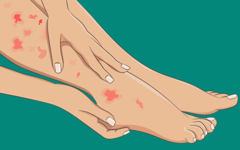 Nổi mẩn đỏ ở chân: Nếu chân bạn nổi những đốm màu đỏ tươi, đỏ sẫm hoặc tím và có thể đi kèm với một số phản ứng như ngứa, dát trong thời gian dài, thì đây cũng có thể là đấu hiệu cảnh báo bệnh viêm mạch máu, và một số bệnh tự miễn dịch như lupus hoặc viêm khớp dạng thấp.