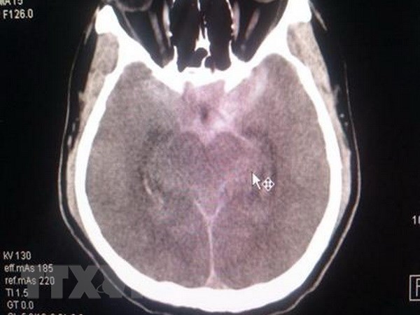 Hình ảnh CT sọ của bệnh nhân trước can thiệp. (Ảnh: TTXVN phát)