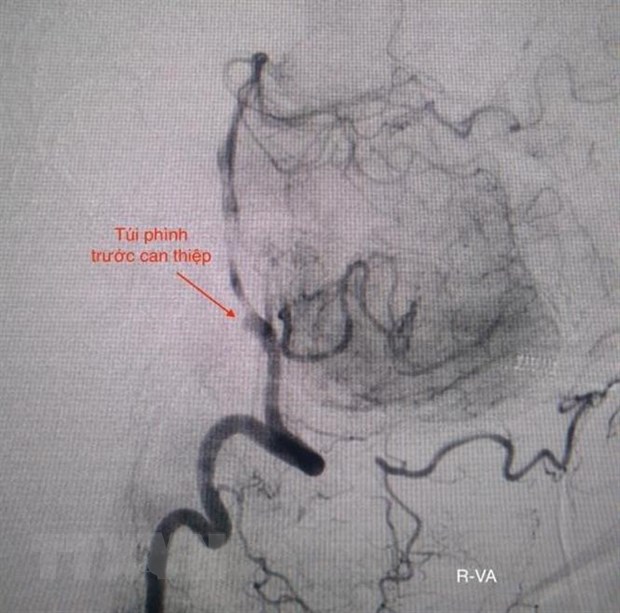 Hình ảnh túi phình động mạch trước can thiệp. (Ảnh: TTXVN phát)