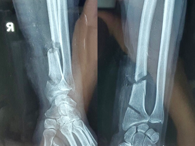 Hình ảnh X-quang cho thấy xương cánh tay của bệnh nhân bị máy cưa cắt đứt lìa. Ảnh: Đình Tuyển