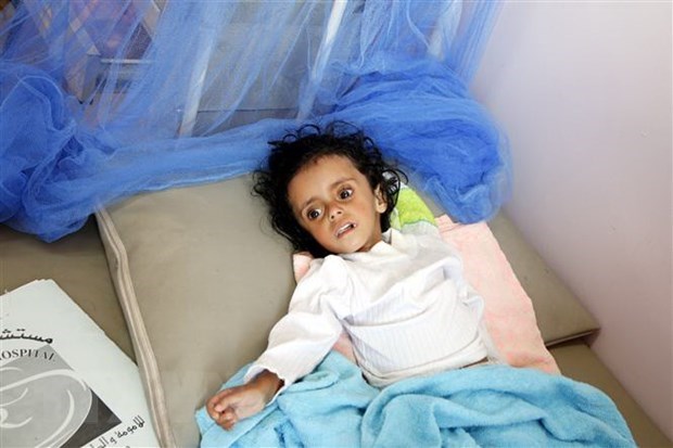 Vietnam calls for joining hands in preventing famine in Yemen A malnourished child treated at a hospital in Sanaa, Yemen (Photo: Xinhua/VNA)