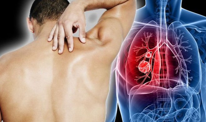 Nếu lưng trên bị đau liên tục, có thể là dấu hiệu của một khối u ung thư phổi. Ảnh: SHUTTERSTOCK