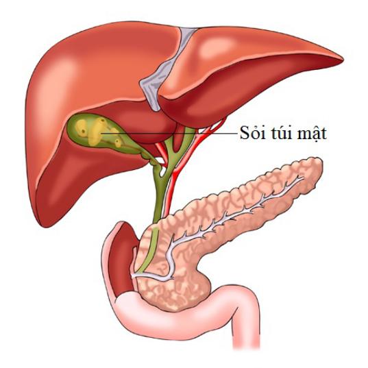 Sỏi túi mật: Dấu hiệu, nguyên nhân và điều trị