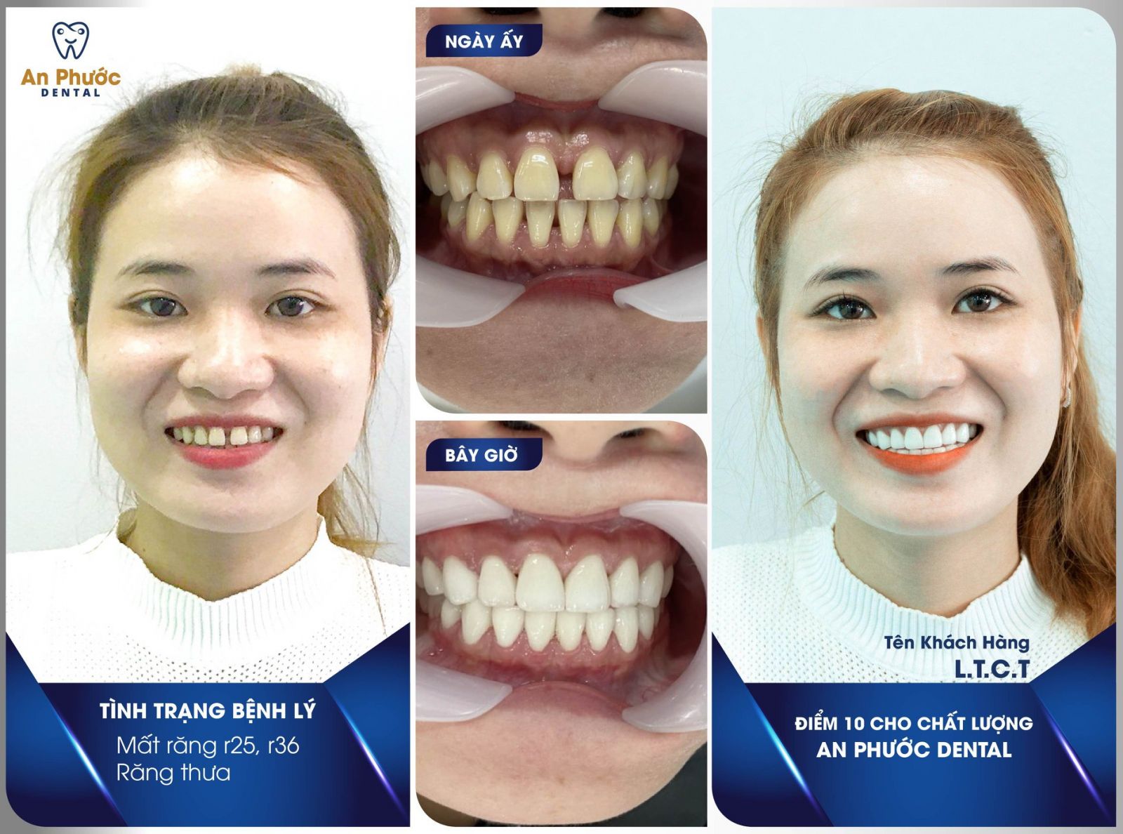 Bọc răng sứ được nhiều khách hàng tại Long An lựa chọn để sở hữu nụ cười rạng rỡ đầu xuân