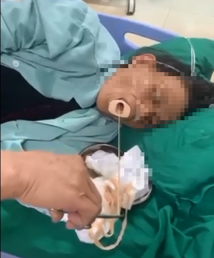 Các bác sĩ gắp sán dây dài 6m từ dạ dày bệnh nhân - Ảnh: Bệnh viện cung cấp