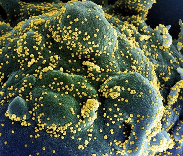 Một tế bào (xanh dương/xanh lục) bị nhiễm nặng các hạt virus SARS-CoV-2 (màu vàng), được phân lập từ mẫu của bệnh nhân COVID-19. (Ảnh: AFP/TTXVN)