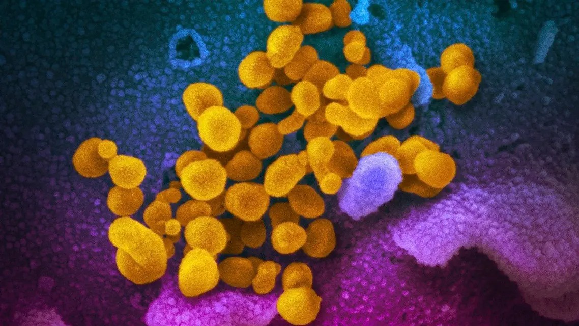Phát hiện biến thể SARS-CoV-2 có thể lây nhiễm mạnh hơn BA.2 Hình ảnh do Viện Nghiên cứu Y tế quốc gia Mỹ cho thấy hình ảnh virus SARS-CoV-2 (màu vàng) trên bề mặt tế bào ở một bệnh nhân Covid-19. Ảnh AFP