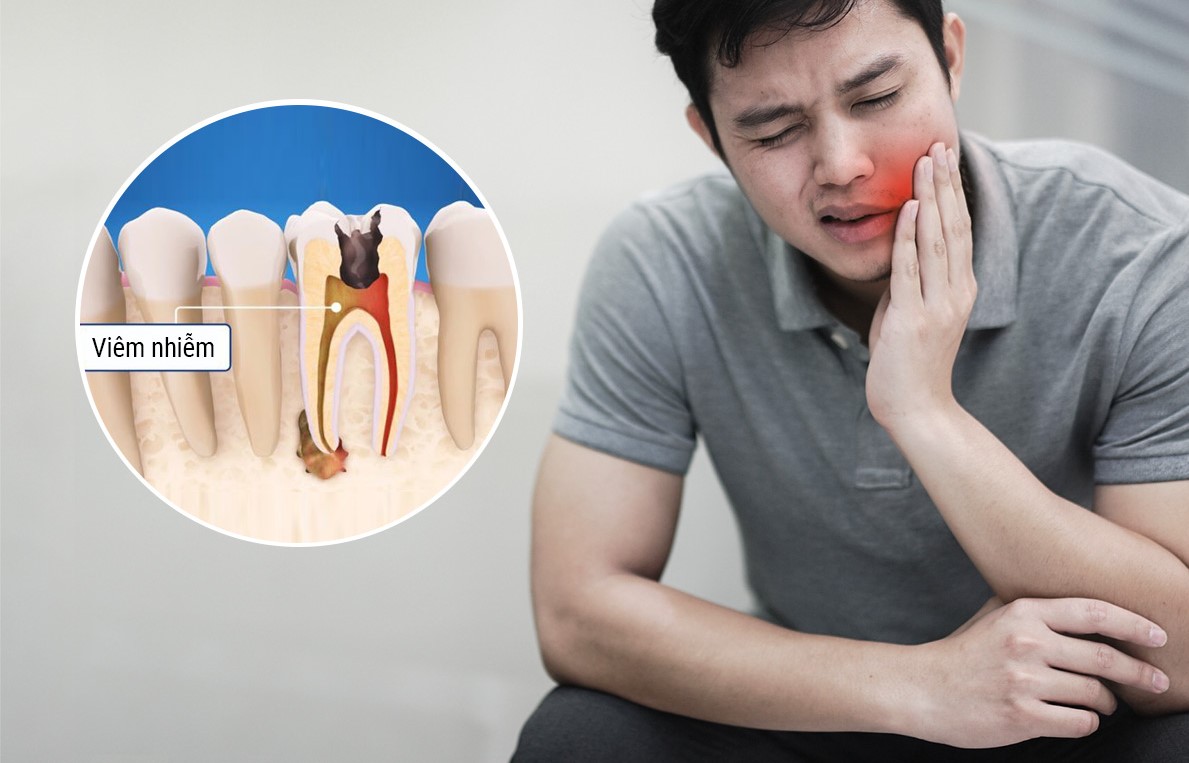 Cách trị sâu răng hiệu quả và an toàn