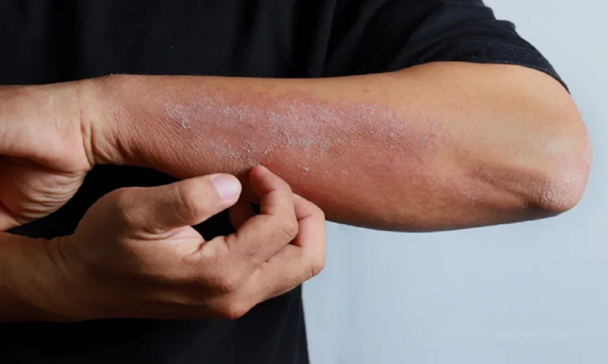5 dấu hiệu trên da cảnh báo bệnh thận