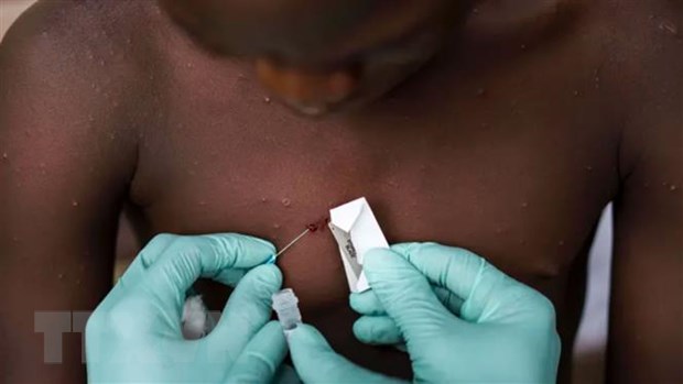 Nhân viên y tế điều trị cho một bệnh nhân mắc bệnh đậu mùa khỉ tại Nigeria. (Ảnh: Getty Images/TTXVN)