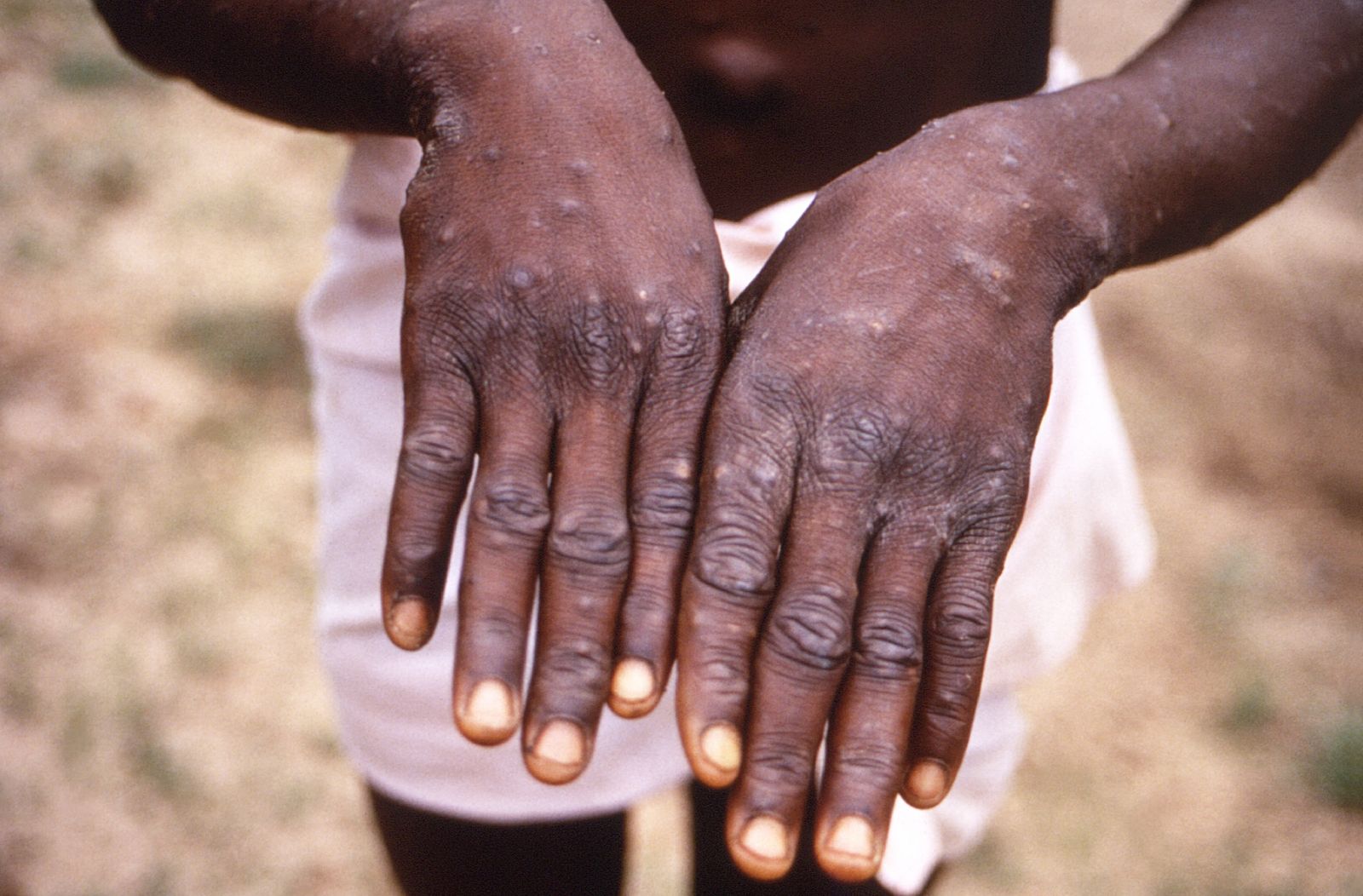 Bệnh nhân đậu mùa khỉ có các nốt trên da. Ảnh AFP