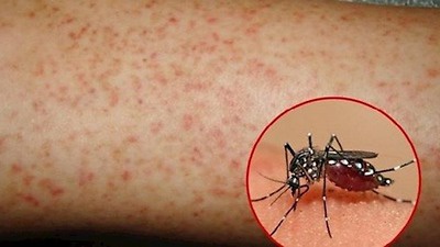 Muỗi đốt người bệnh sốt xuất huyết rồi lại đốt người khỏe mạnh làm lây lan bệnh. Ảnh Cục YTDP