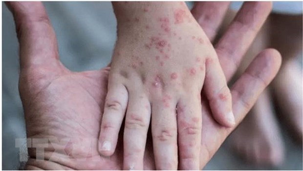 Bộ Y tế: Việt Nam hiện chưa ghi nhận trường hợp mắc đậu mùa khỉ