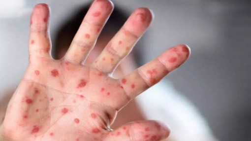 Cha mẹ cần làm gì khi trẻ mắc bệnh đậu mùa khỉ? Cha mẹ cần làm gì khi trẻ mắc bệnh đậu mùa khỉ?