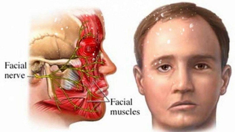 Phòng tránh liệt dây thần kinh số 7 do trời lạnh