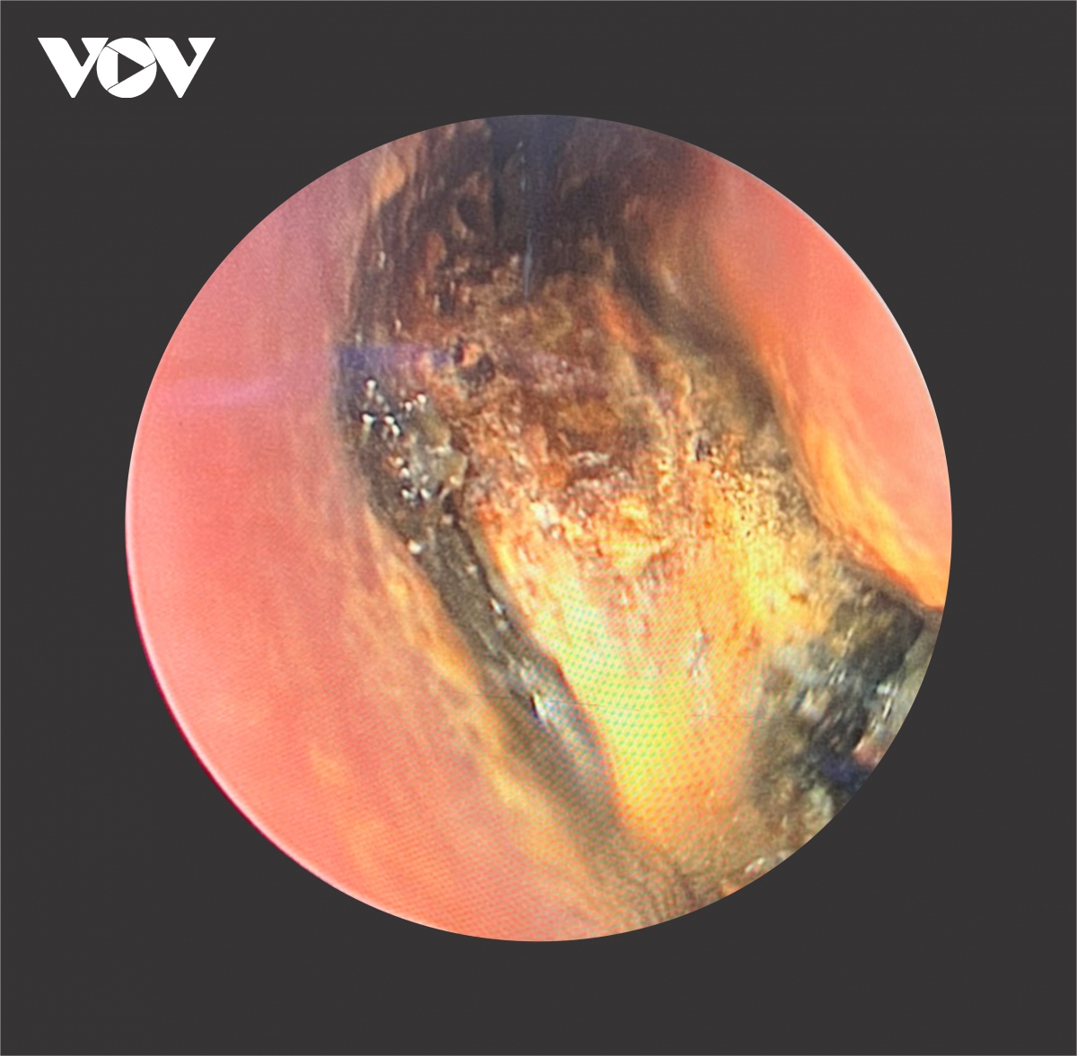 Nội soi thành công lấy dị vật là pin cháy khét nằm trong mũi của một bé gái 6 tuổi