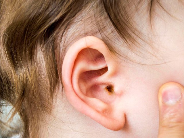 Biến chứng nguy hiểm khi trẻ bị viêm tai giữa