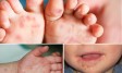 Đã có trẻ tử vong nghi mắc tay chân miệng: 6 khuyến cáo của Bộ Y tế phòng chống bệnh cần biết