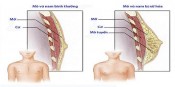 Nam giới sở hữu vòng 1 'khủng', có sao không?