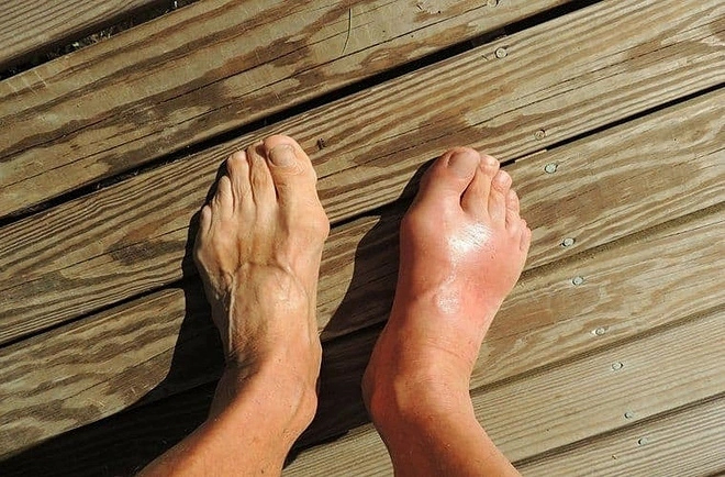 Nồng độ axit uric bình thường vẫn có thể bị gout
