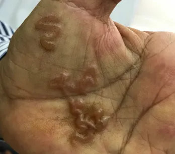 Vì sao không dễ trị giun đũa chó mèo?
