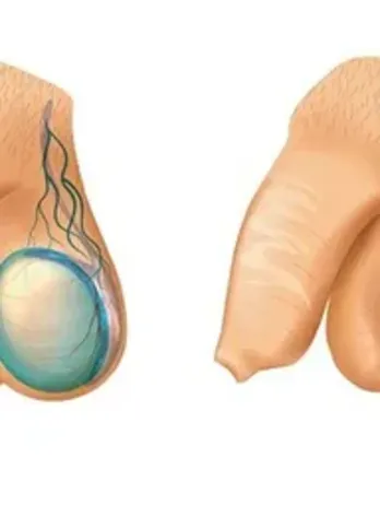 Giãn tĩnh mạch tinh gây vô sinh ở nam giới
