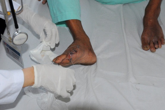 Biến chứng đái tháo đường gây hoại tử bàn chân phải của bệnh nhân L.H.P.