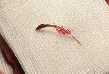 Phẫu thuật lấy đoạn xương cá dài khoảng 2,5 cm trong ruột một bệnh nhân