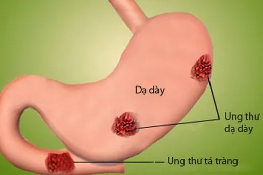 Báo động các loại ung thư liên quan đến đường tiêu hóa ngày càng trẻ hóa