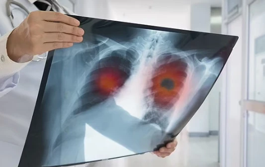 Ung thư phổi là mối quan tâm sức khỏe nổi bật đối với nam giới. Ảnh Shutterstock