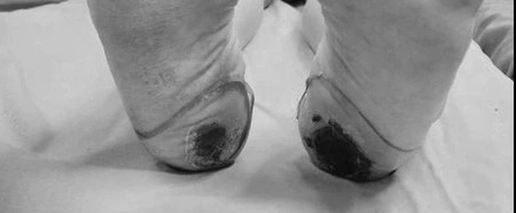 Suýt liệt vĩnh viễn vì đắp lá chữa đau lưng